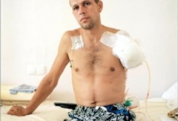 Життя після війни: «Або живеш без руки, або помираєш із двома»